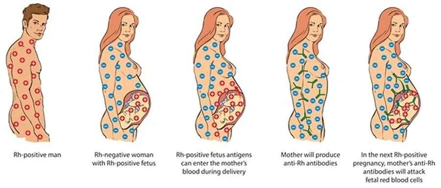 Diagram of a rhesus-negative mother and rhesus-positive father