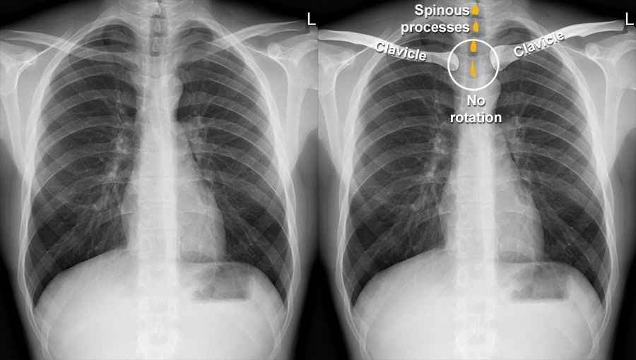 Normal chest X-ray