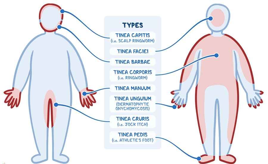 Fungal infections