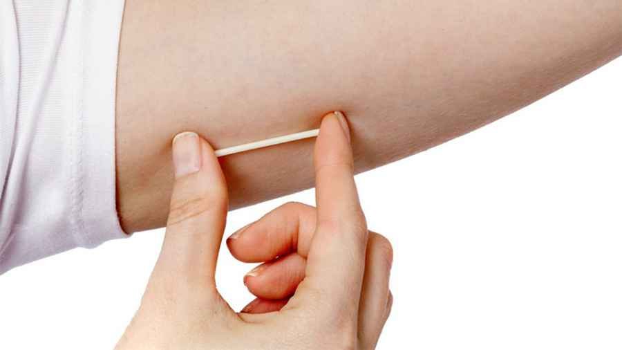 Implant contraceptive