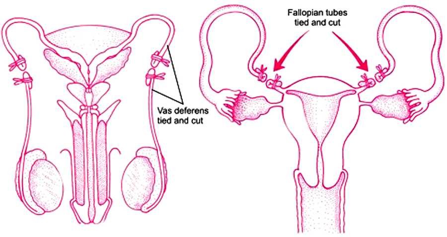 Vasectomy and Tubular ligation