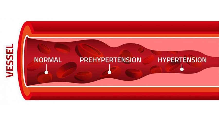 Diagram of a blood vessel in a normal and hypertensive state