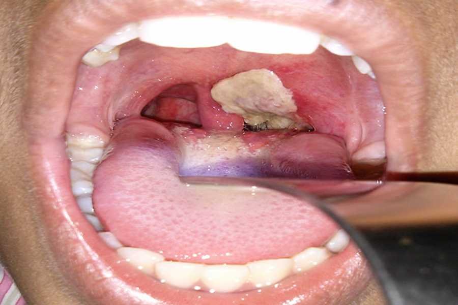 Image of a child with a diphtheria thick coating in the throat