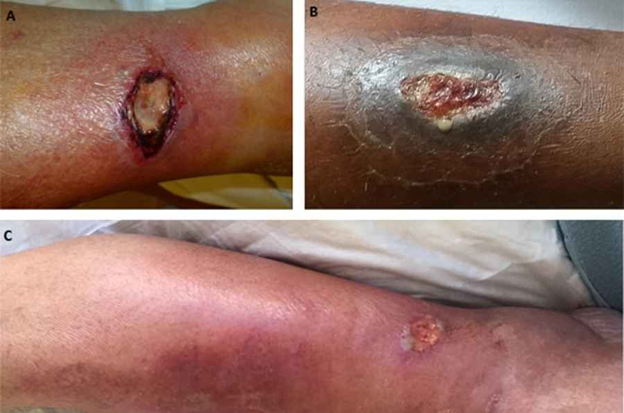 Pictures of cutaneous diphtheria ulcers