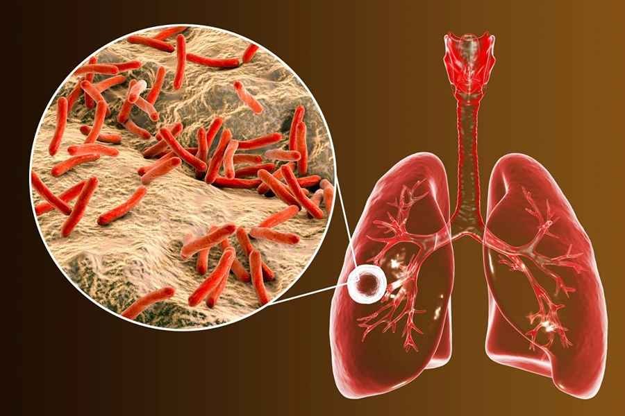 Diagram of mycobacterium baciili in the lungs