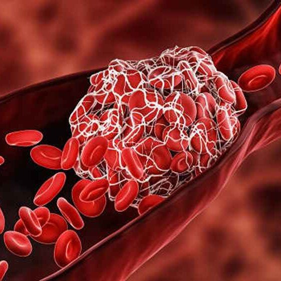 Diagram of a clot in a blood vessel