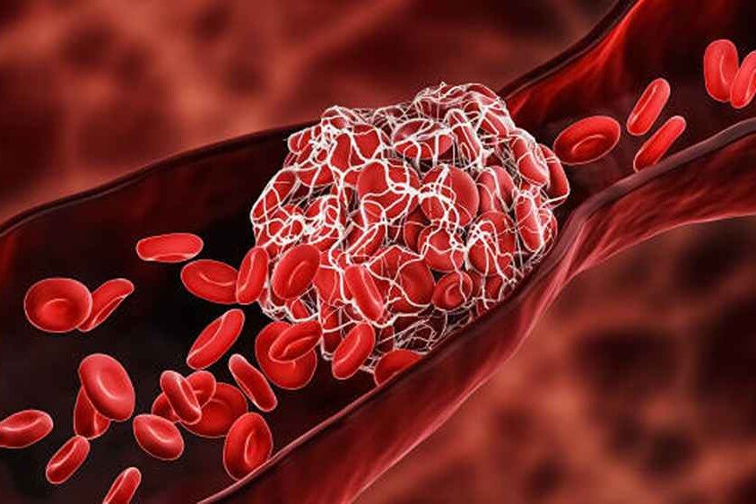 Diagram of a clot in a blood vessel